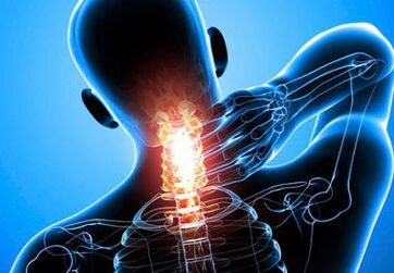 intense neck pain with advanced osteochondrosis