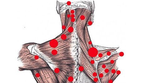Trigger points in muscles that provoke myofascial back pain