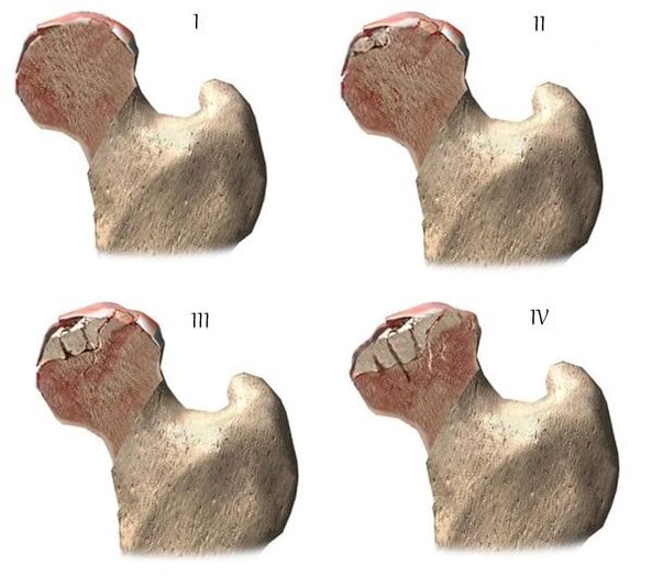 stages of arthrosis of the hip joint