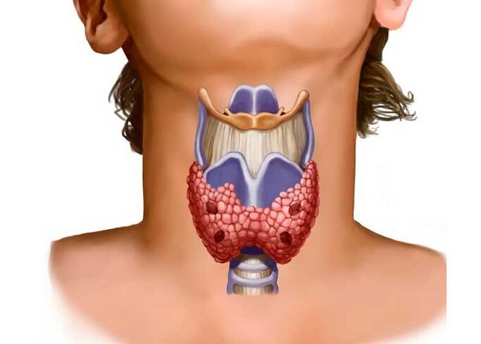 thyroid problems as a cause of neck pain
