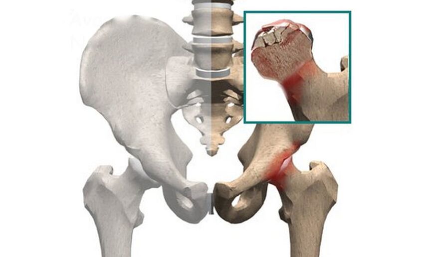Necrosis of the femoral head is one of the causes of pain in the hip joint