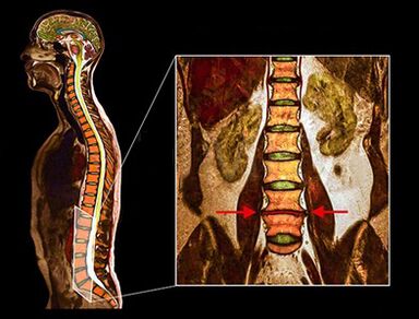 Degenerative disk in the spine