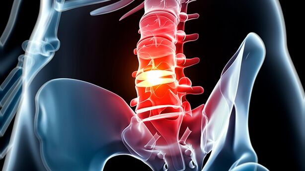 osteochondrosis of the lumbar spine
