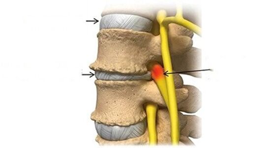 spinal disc problems