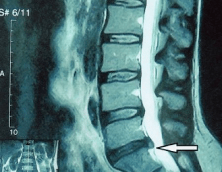 protrusion of a spinal disc on an MRI scan