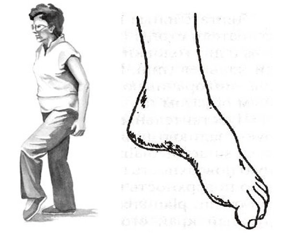 steppage or cock gait for osteochondrosis
