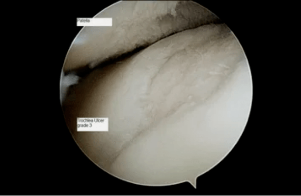 astroscope view of a knee joint with arthrosis of the 3rd degree