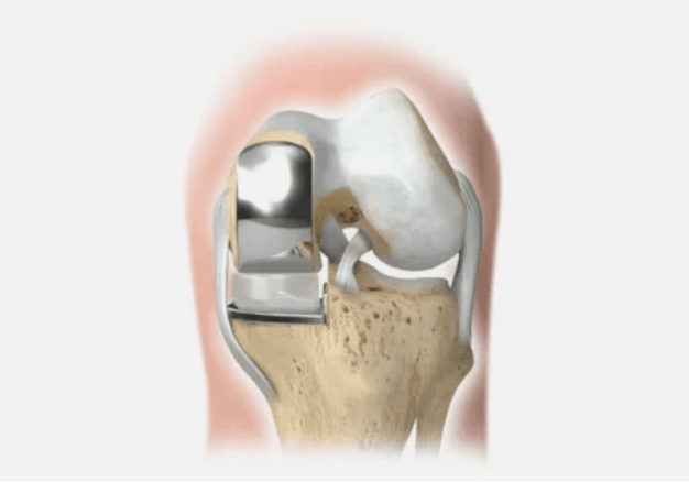 one part of the joint is damaged
